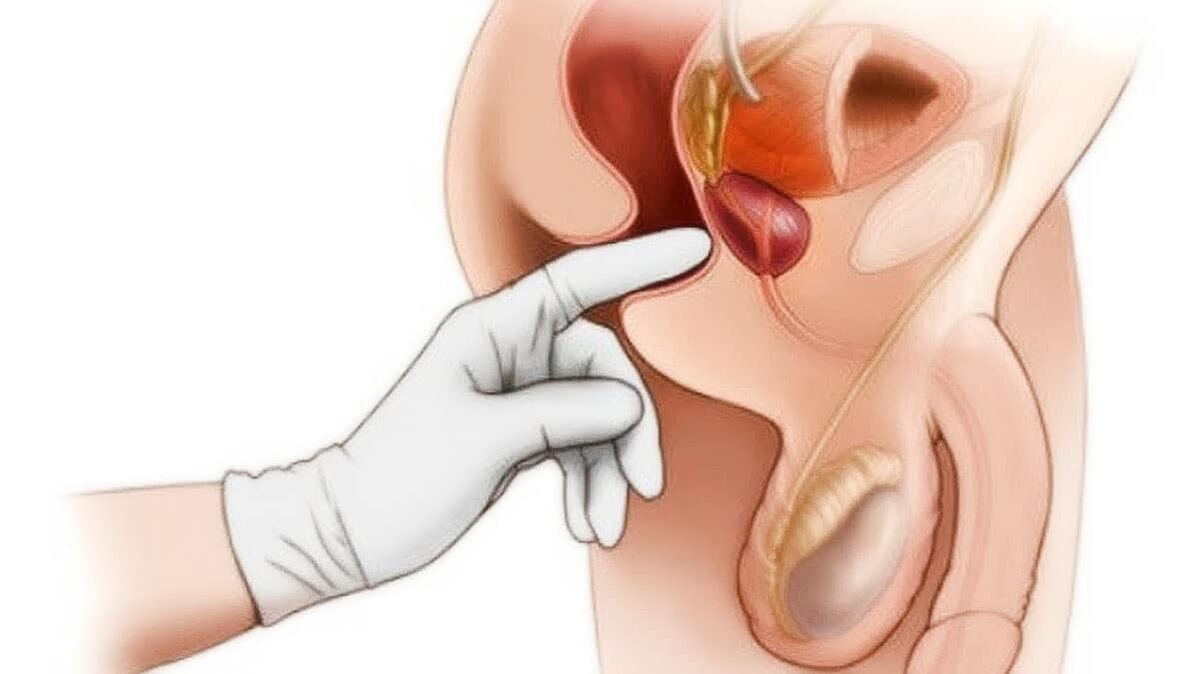 Diagnostic de la prostatite et son traitement avec l'appareil
