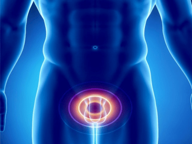 Prostatite – inflammation de la prostate chez l'homme