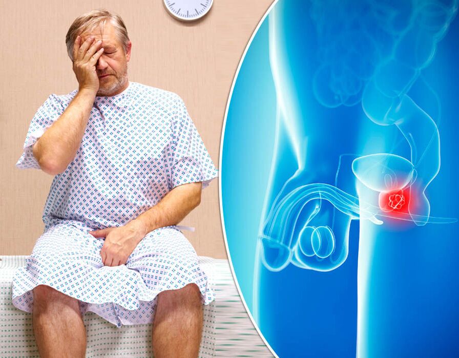Une maladie est diagnostiquée chez un homme atteint de prostatite