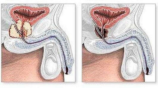 Avant et après le traitement chirurgical de la prostatite chronique
